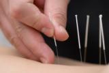 acupuncture et relaxation